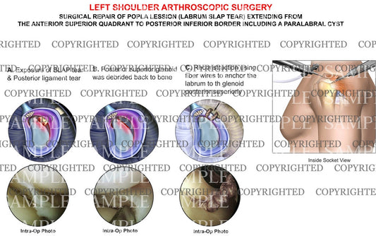 Labral SLAP tear repair