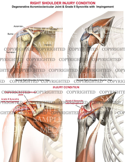 Right shoulder injury condition