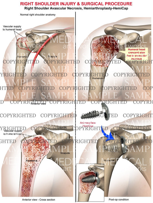 Right Shoulder injury & Surgical procedure