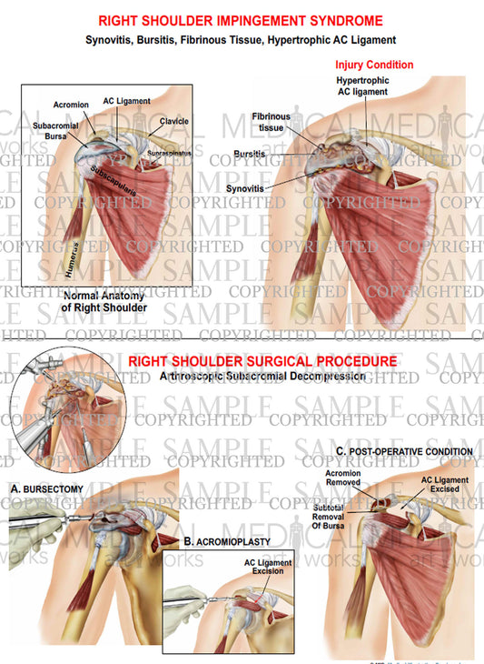 Right shoulder impingement syndrome - Synovitis - Bursitis and Arthroscopic repair