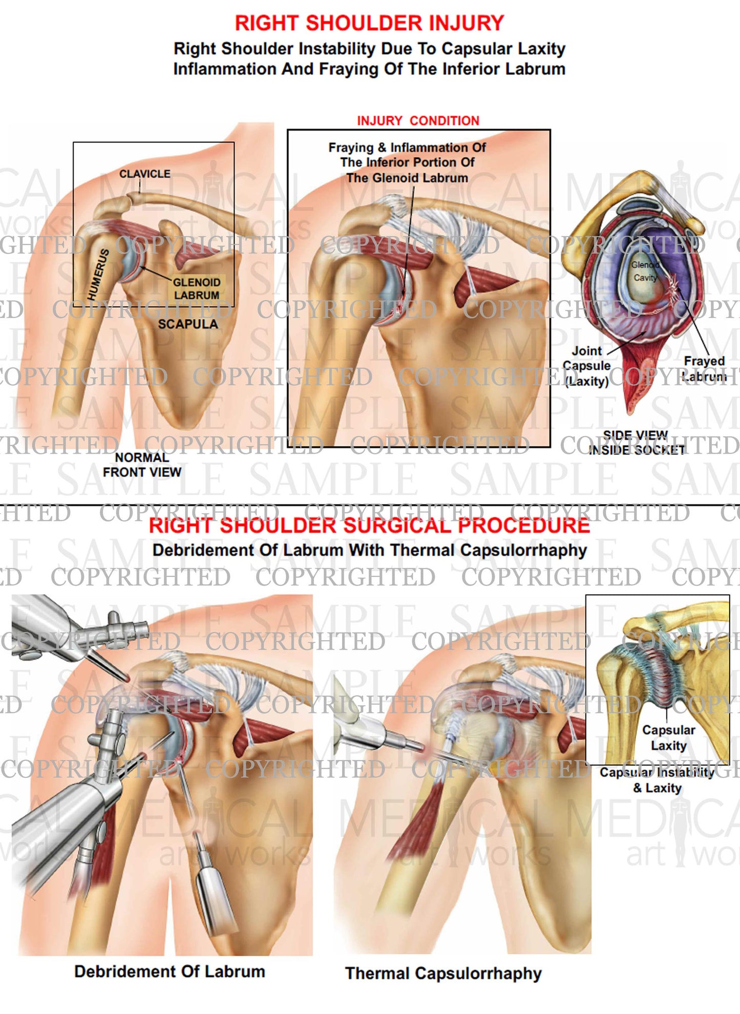 Right shoulder instability, laxity - Surgical debridement with thermal capsulorrhaphy