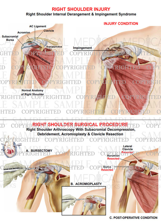 Right shoulder internal derangement - arthroscopic repair - Subacromial decompression