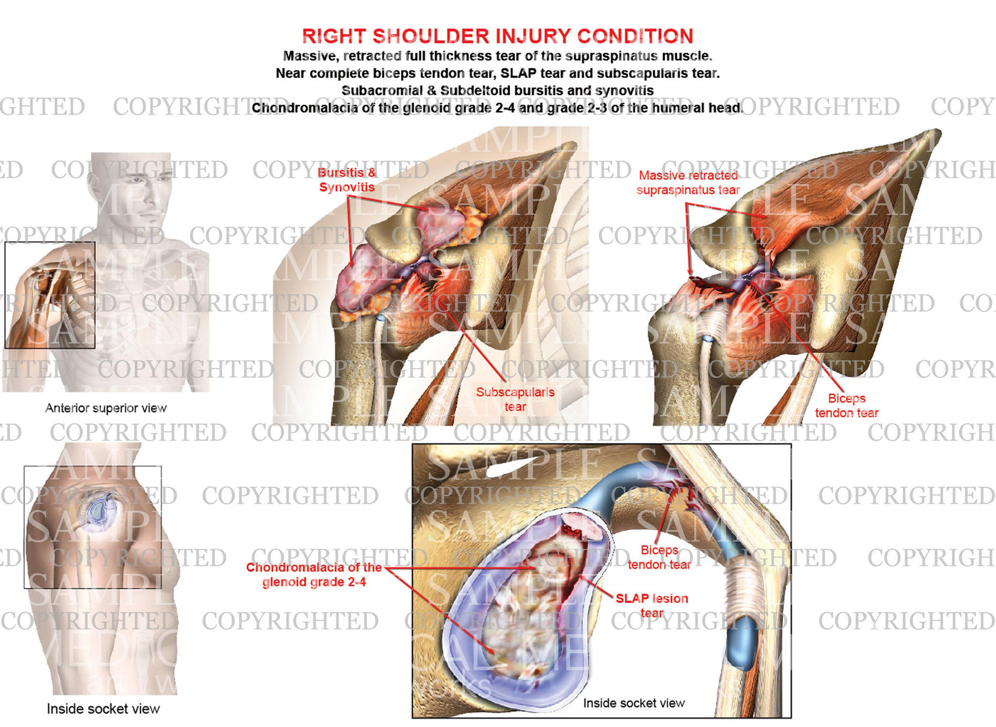 Right shoulder Impingement syndrome - Complete rotator cuff tear - SLAP tear - Bursitis - Synovitis