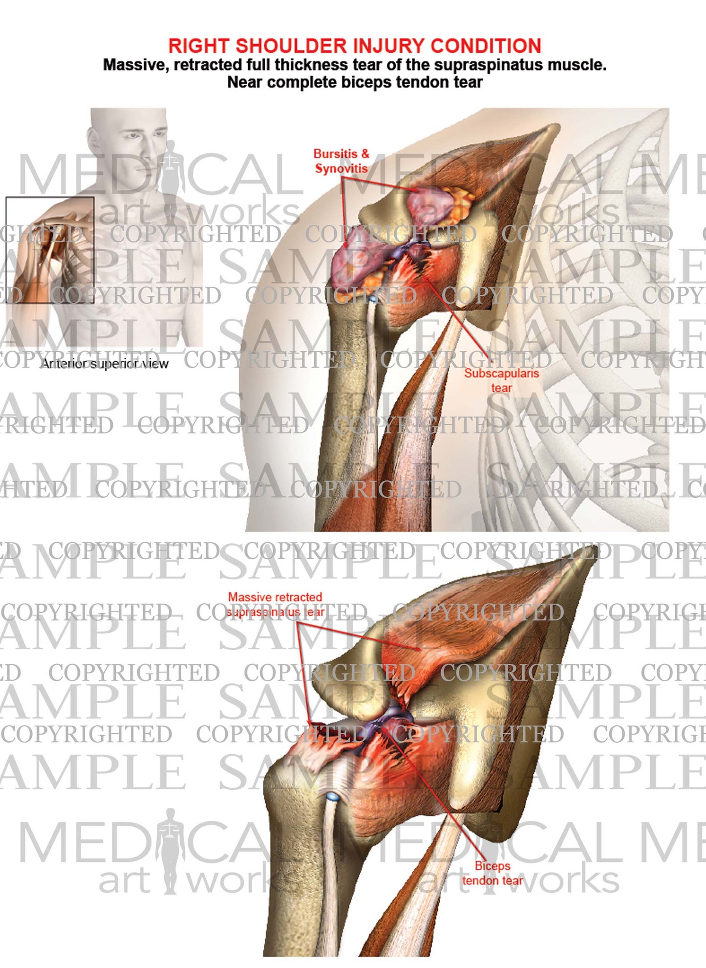 Right shoulder complete rotator cuff tear - Biceps tendon tear