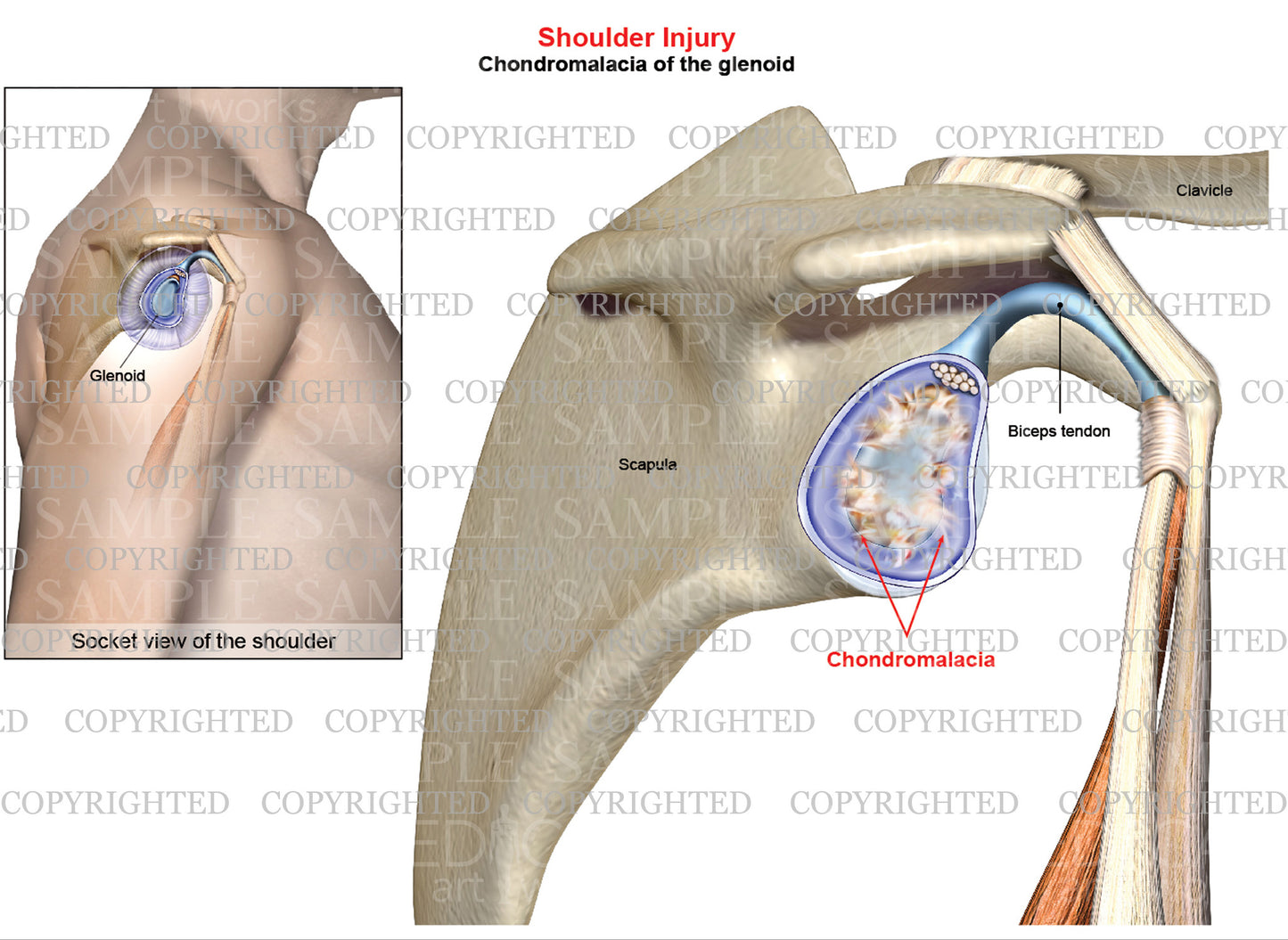 Chondromalacia of the glenoid - shoulder