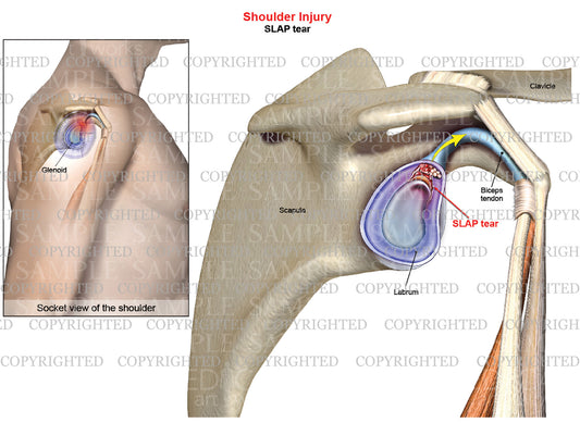 Labral SLAP tear - Shoulder injury