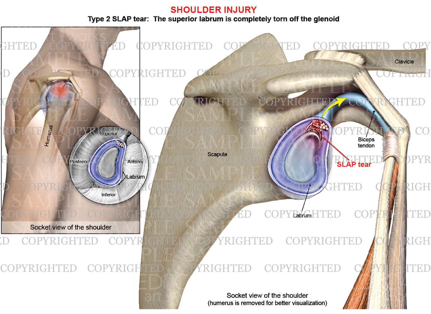 Type 2 SLAP tear - Shoulder injury