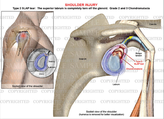 Type 2 SLAP labral tear - Grade 2 & 3 Glenoid chondromalacia - Shoulder injury