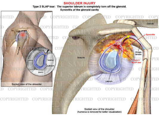 Type 2 SLAP labral tear - Synovitis - Shoulder injury