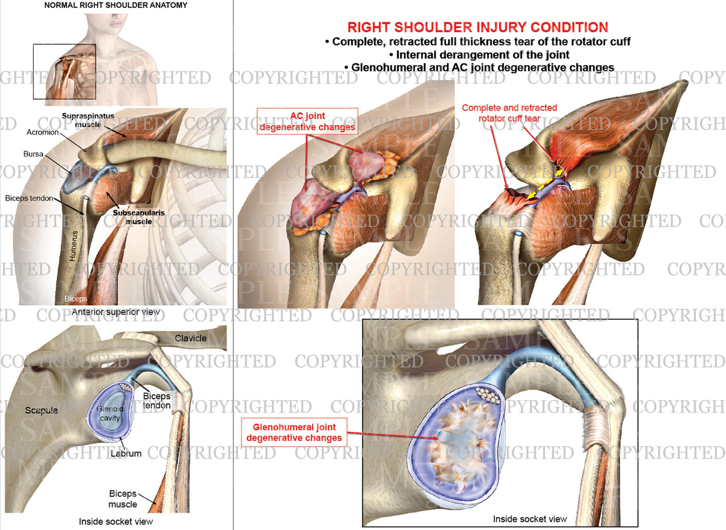 Right shoulder joint internal derangement - Rotator cuff complete retracted tear - Female