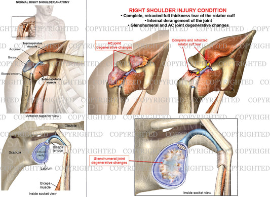 Right shoulder joint internal derangement - Rotator cuff complete retracted tear - Male