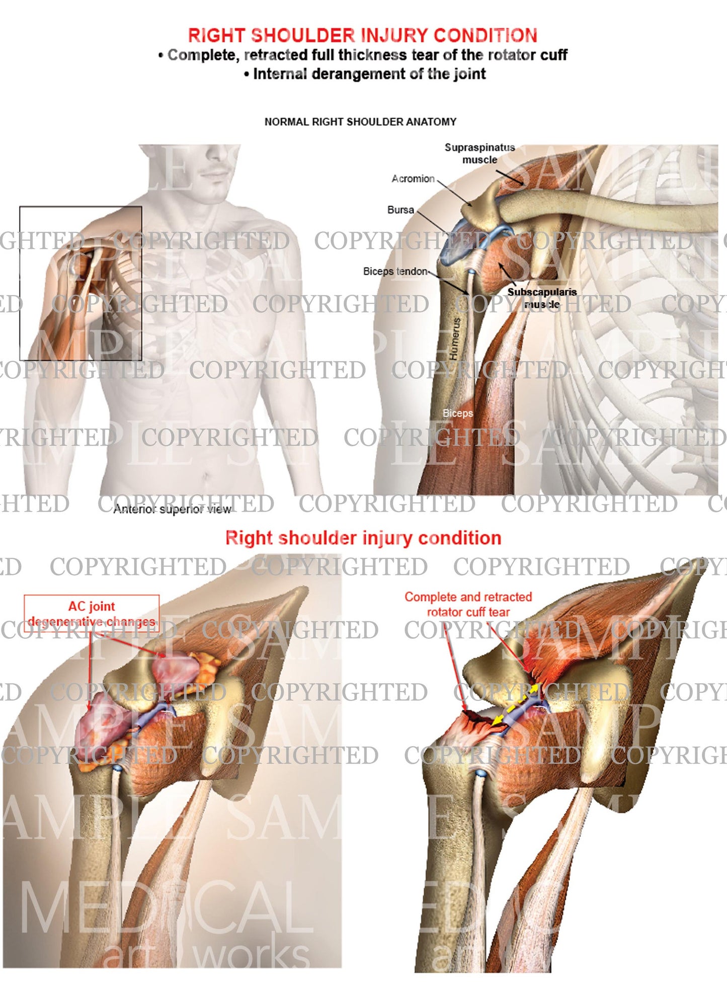 Right shoulder rotator cuff complete retracted tear - Internal derangement - Male