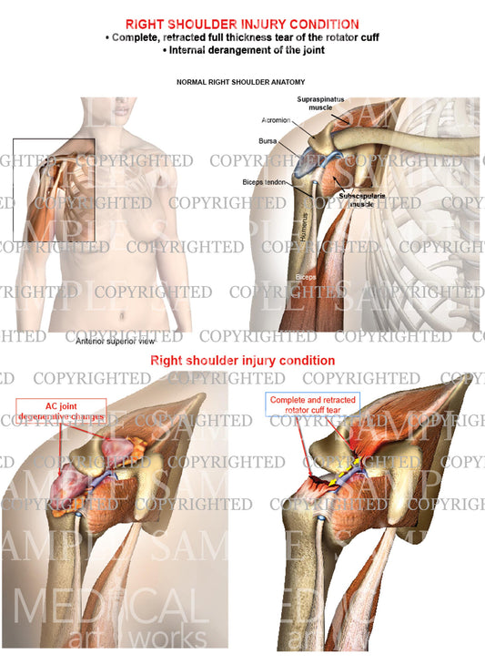 Right shoulder rotator cuff complete retracted tear- Internal derangement - Female