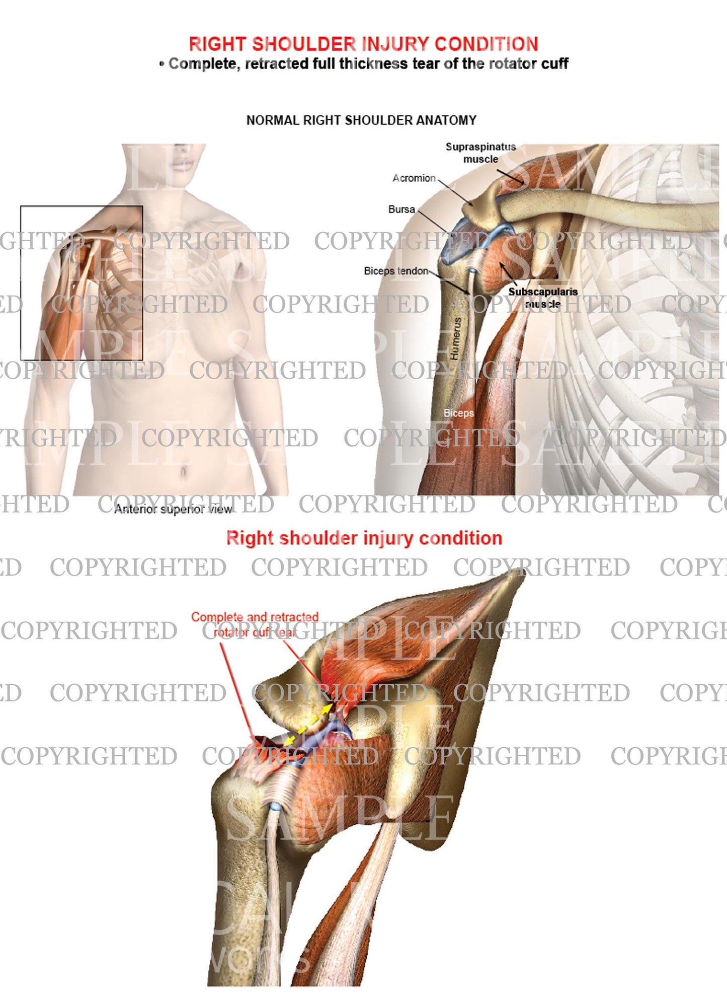 Right shoulder rotator cuff complete retracted tear - Female