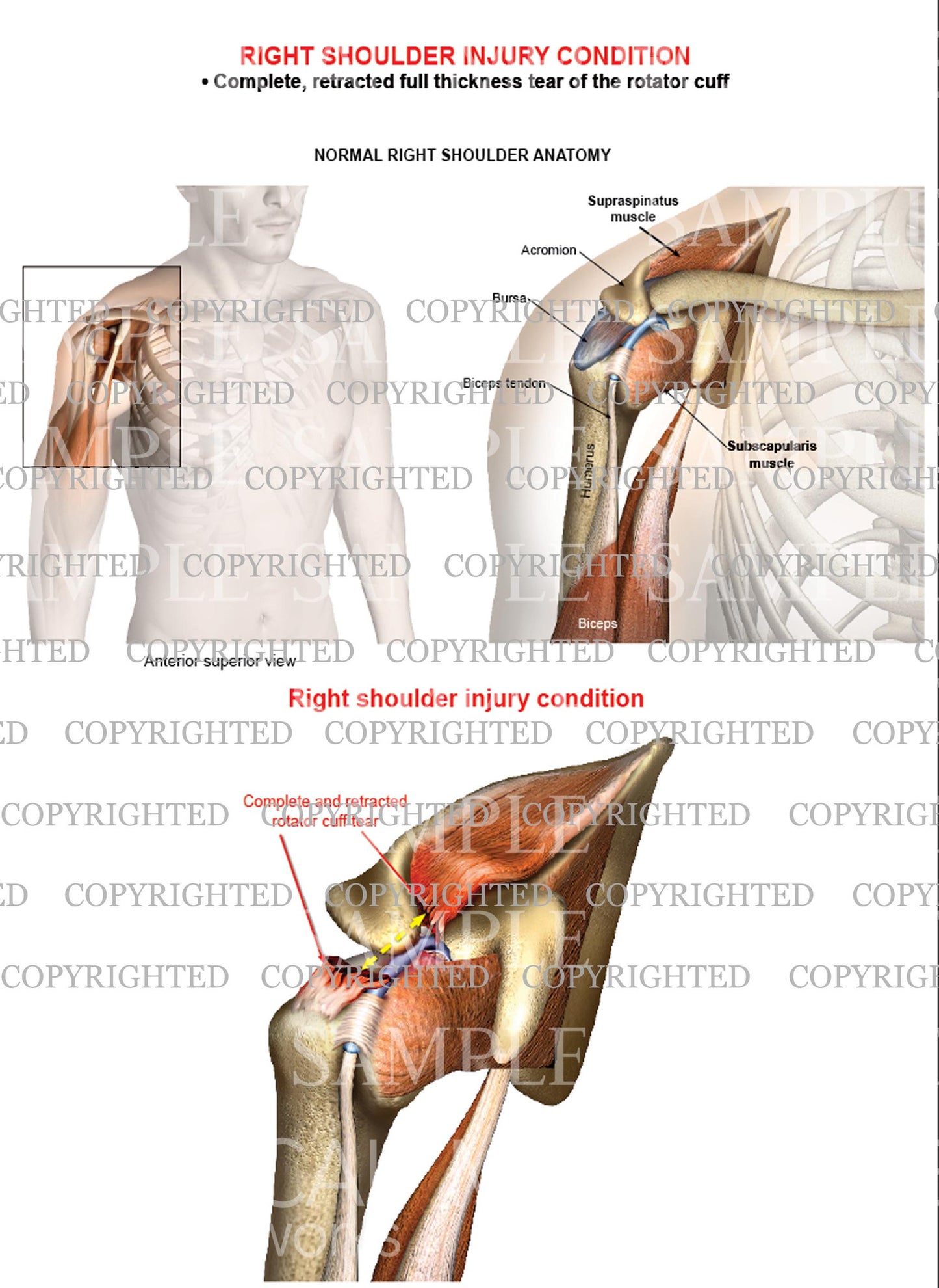 Right shoulder rotator cuff complete retracted tear - Male