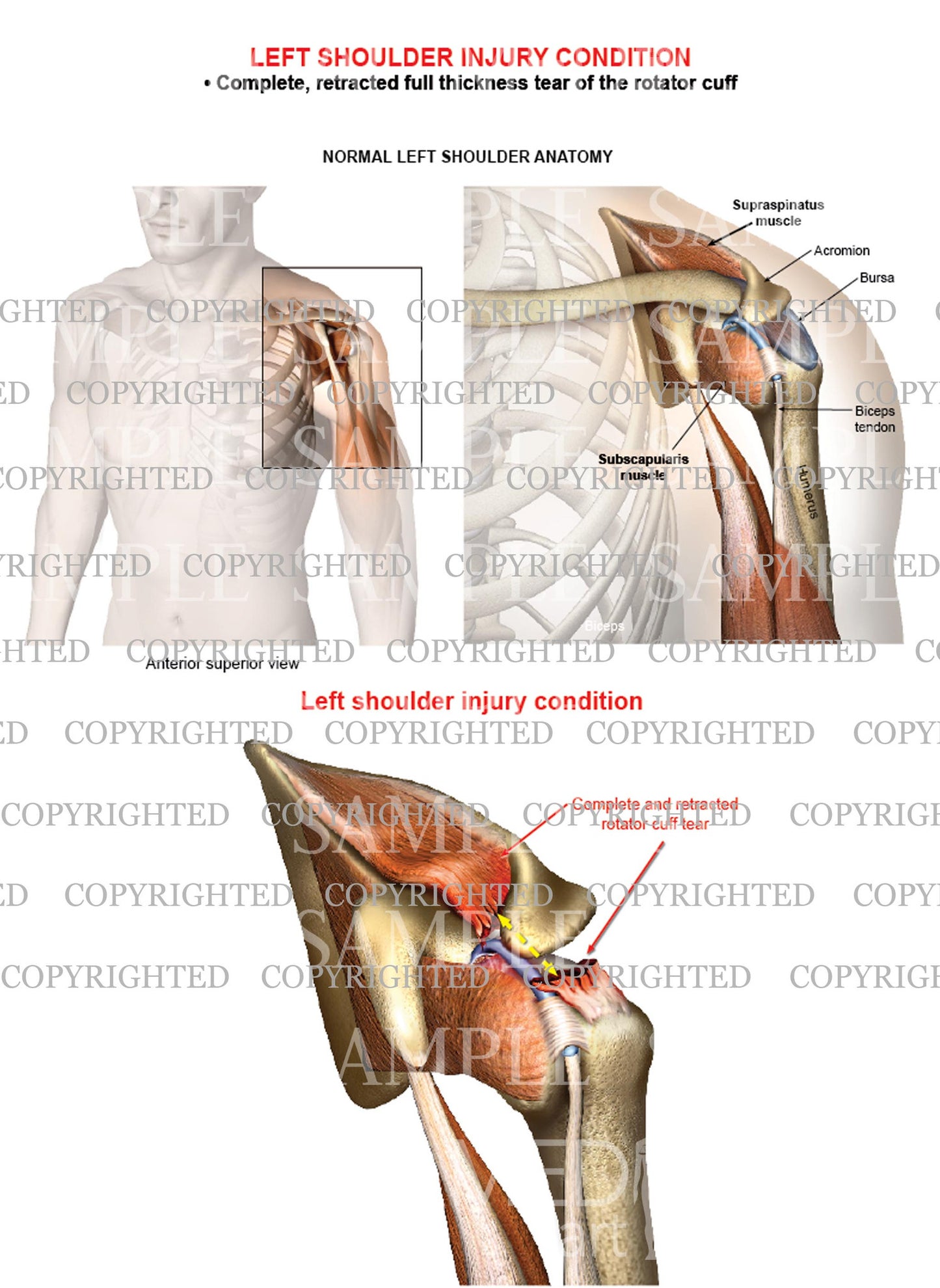 Left shoulder rotator cuff complete retracted tear - Male
