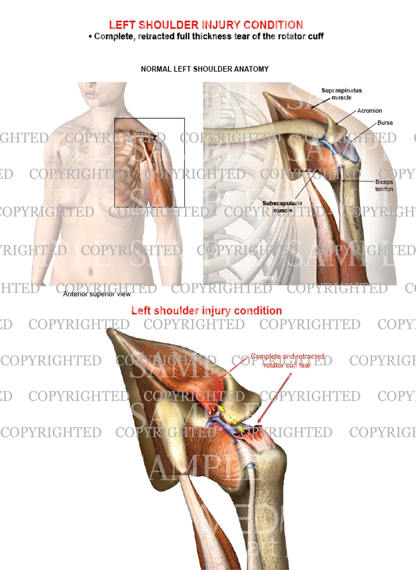 Left shoulder rotator cuff complete retracted tear - Female