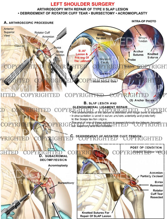 Left Shoulder Surgical arthroscopy