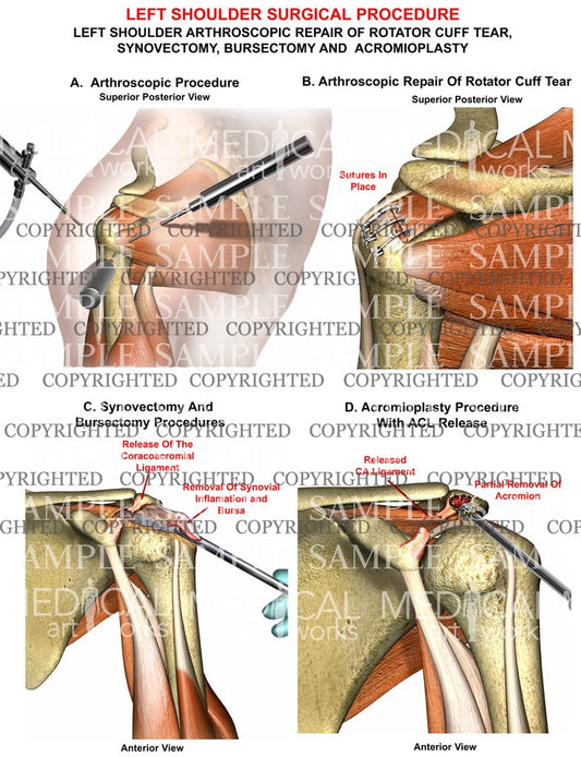 Left Shoulder RC, synovectomy, bursectomy, acromiplasty