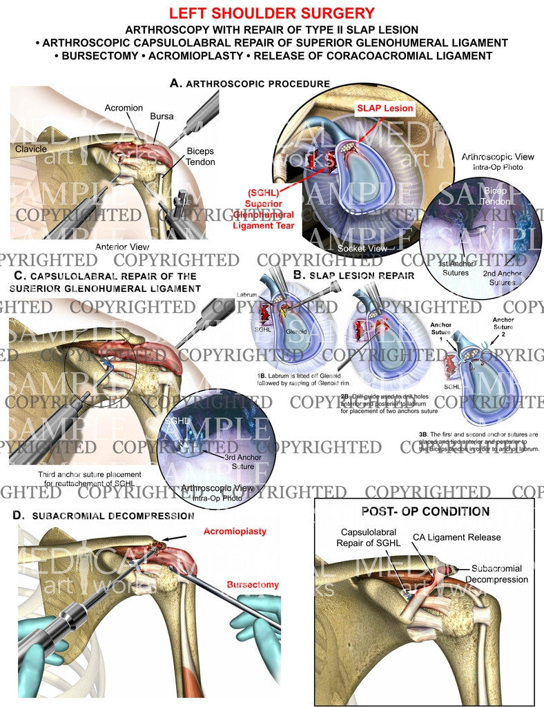 Arthroscopic SLAP, Bursectomy, Acromioplasty