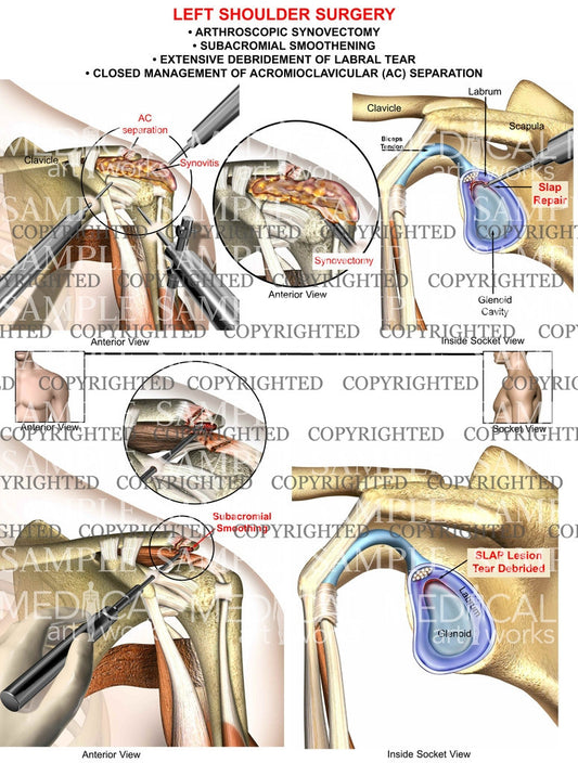 Left labral tear synovectomy+AC