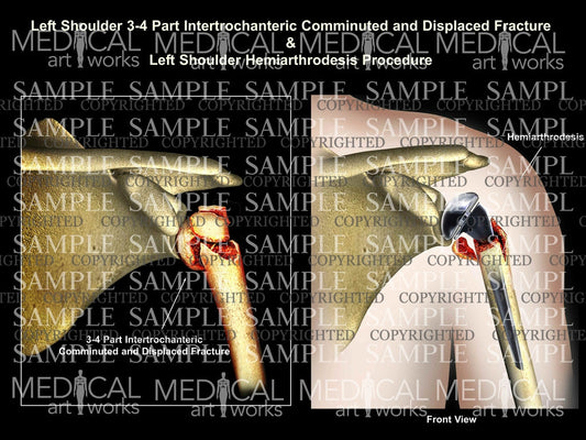 Left shoulder 3 part fracture+Hemiarthrodesis