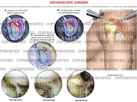 arthroscopic Surgery of shoulder