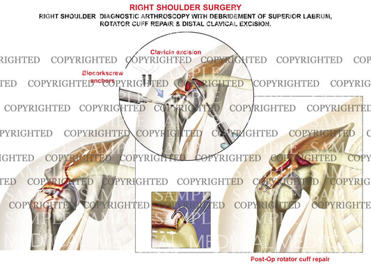 Right Shoulder Arthroscopy procedure 1