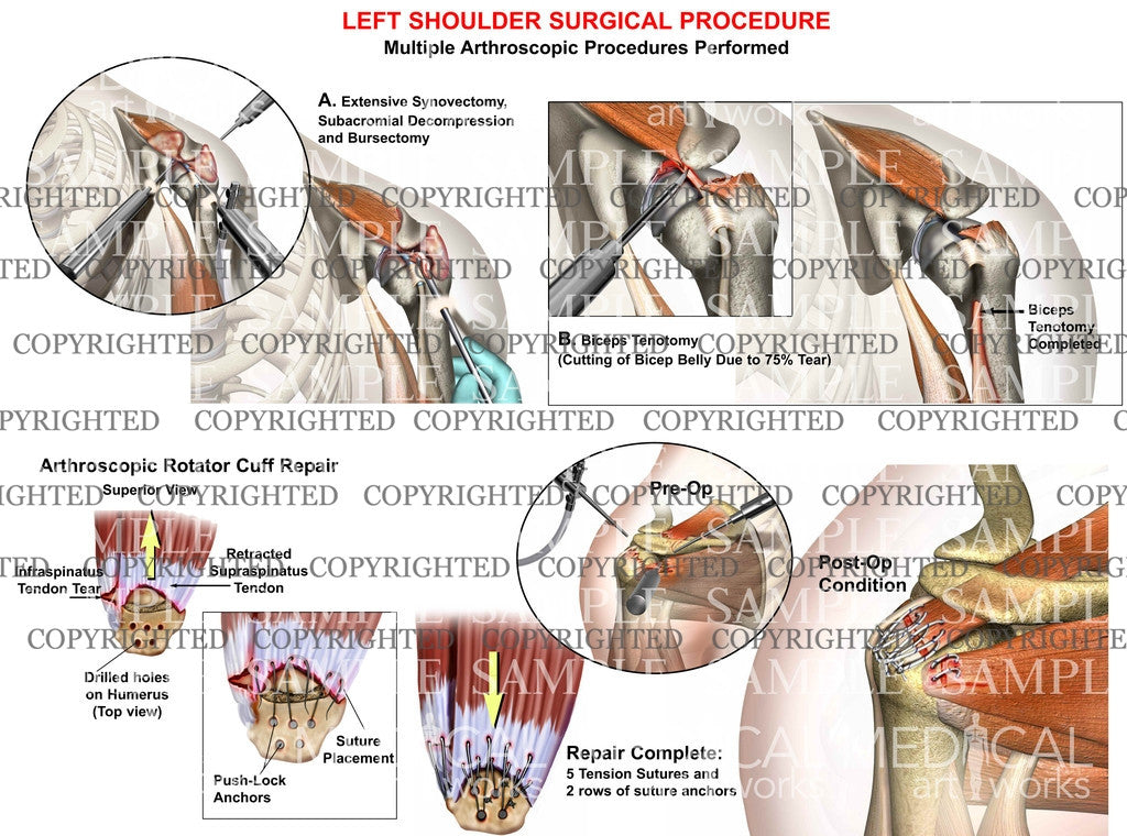 Multiple left shoulder procedures