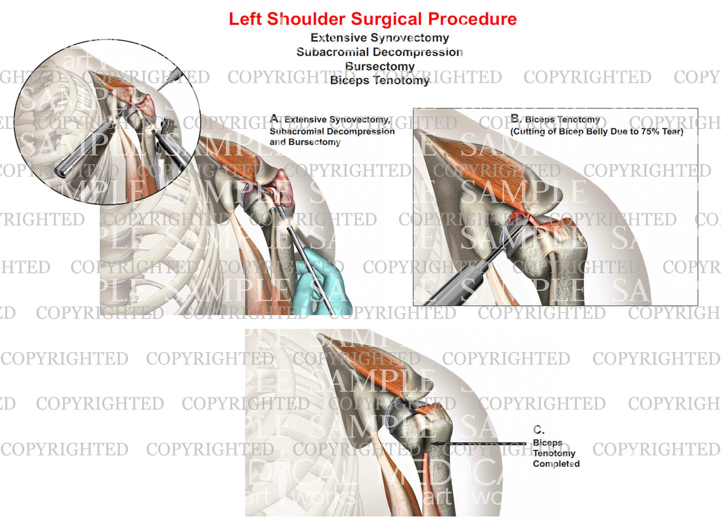 Left shoulder surgery - Synovectomy - Bursectomy - Biceps tenotomy - Subacromial decompression