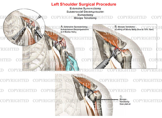 Left shoulder surgery - Synovectomy - Bursectomy - Debridement of RC tear - Subacromial decompression