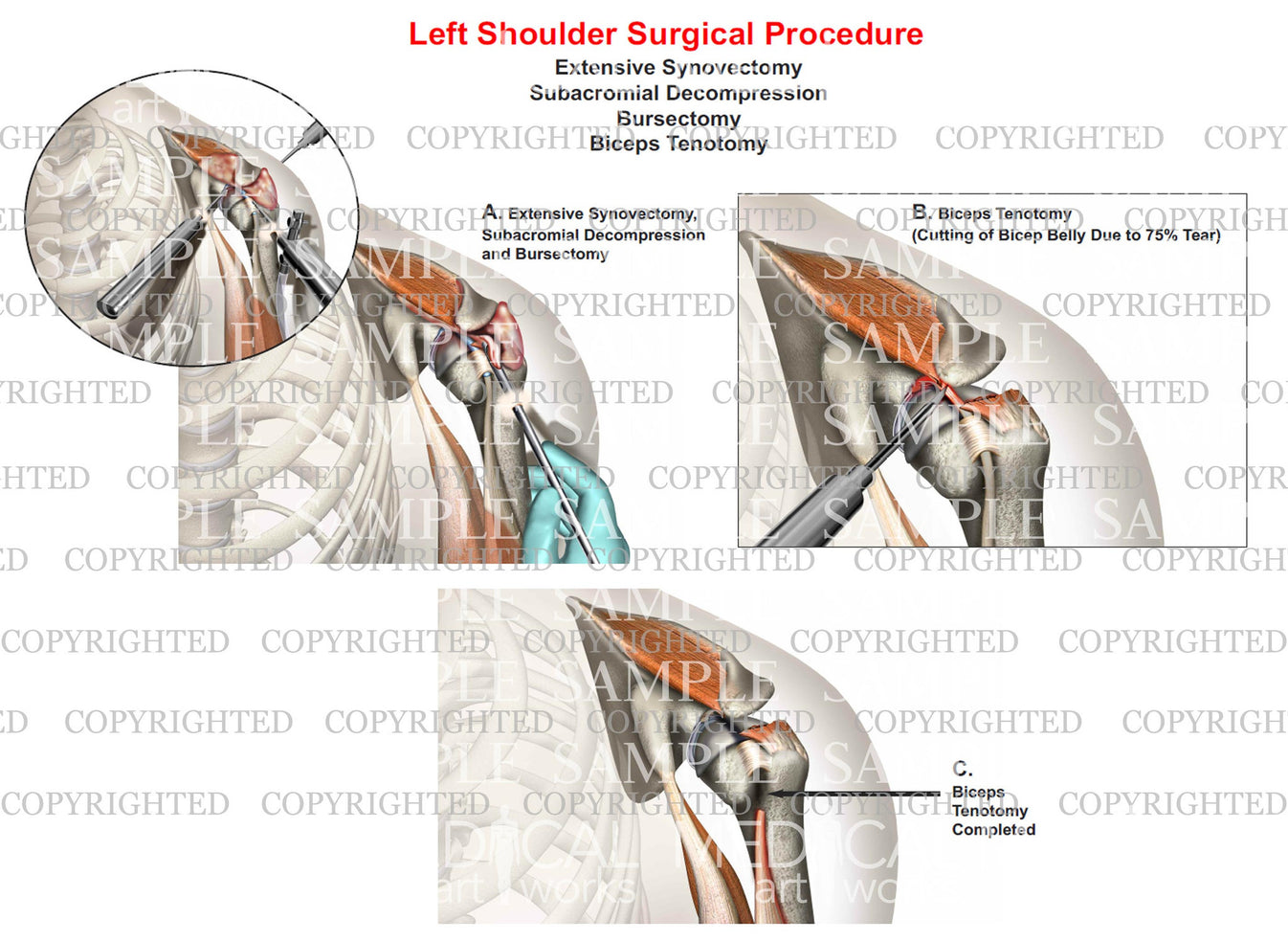 Left shoulder surgery Synovectomy Bursectomy Debridement of RC t