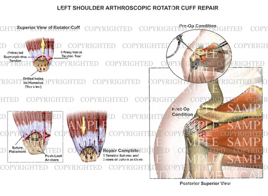 Left shoulder arthroscopic repair of torn rotator cuff