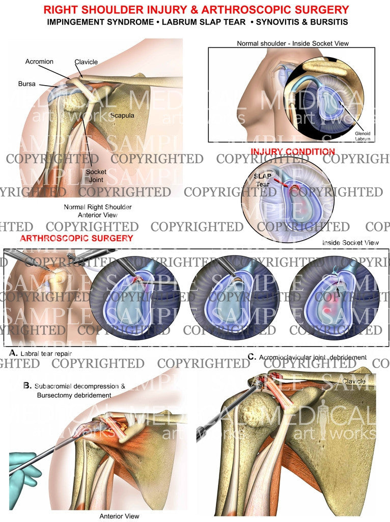 Shoulder Injury & Arthroscopy procedure