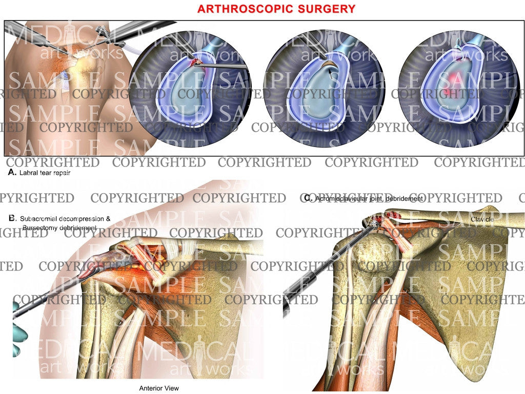 Shoulder Arthroscopy procedure