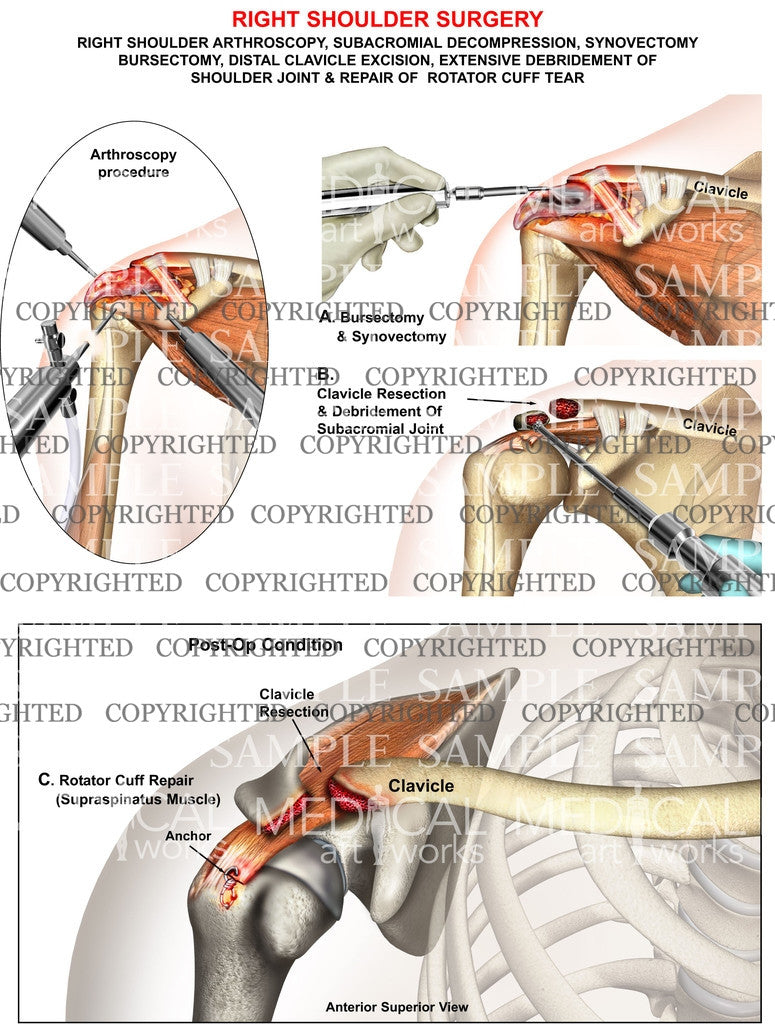 Right shoulder Arthroscopy 
procedure