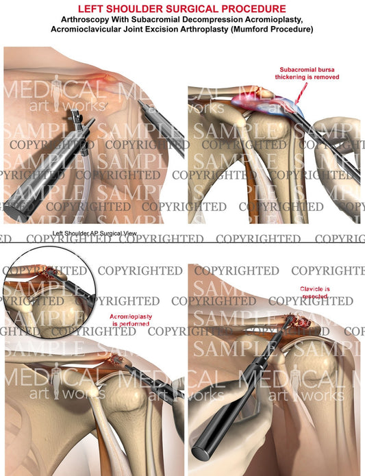 Left Shoulder Arthroscopic decompression Surgical procedure