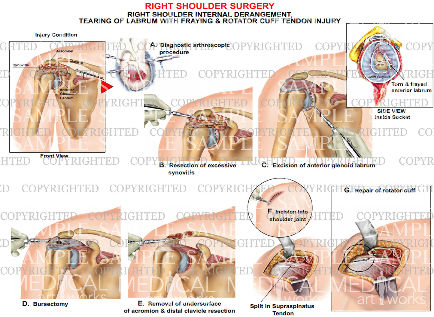 Right shoulder internal derangement - Arthroscopic repair