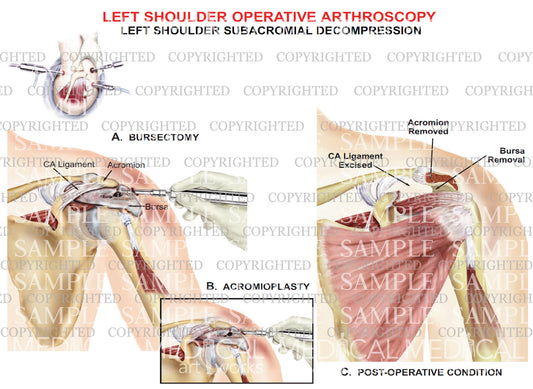 Left shoulder arthroscopic repair - Subacromial decompression