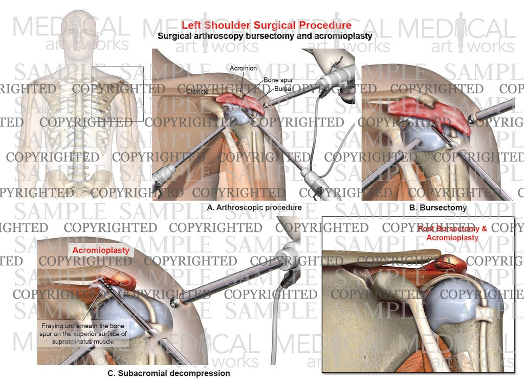 Left arthroscopic surgery bursectomy and acromioplasty