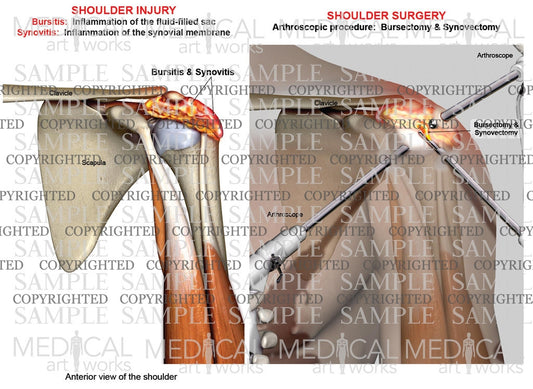 Arthroscopic surgery of bursitis and synovitis