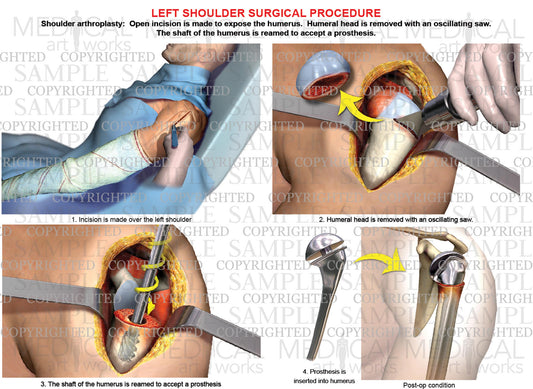 Left shoulder - Arthroplasty - Shoulder replacement