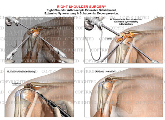 Right shoulder arthroscopic debridement - Synovectomy - Subacromial decompression