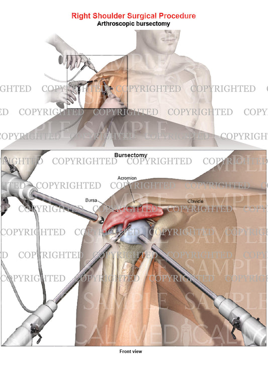 Right shoulder arthroscopic repair - Bursectomy - Male