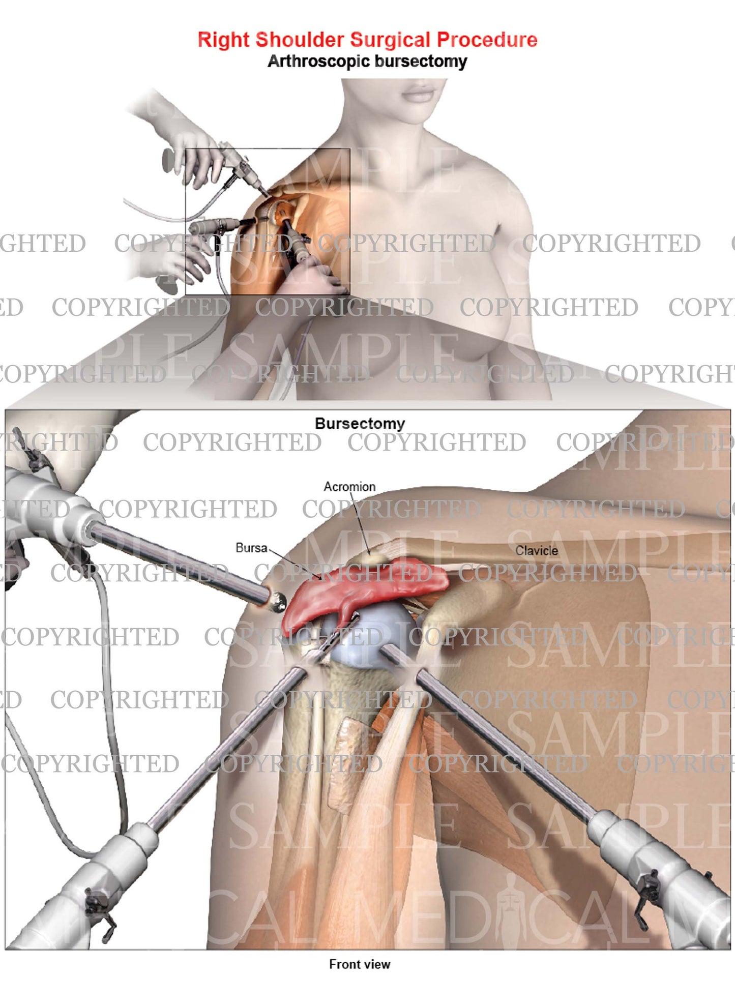 Right shoulder arthroscopic repair - Bursectomy - Female