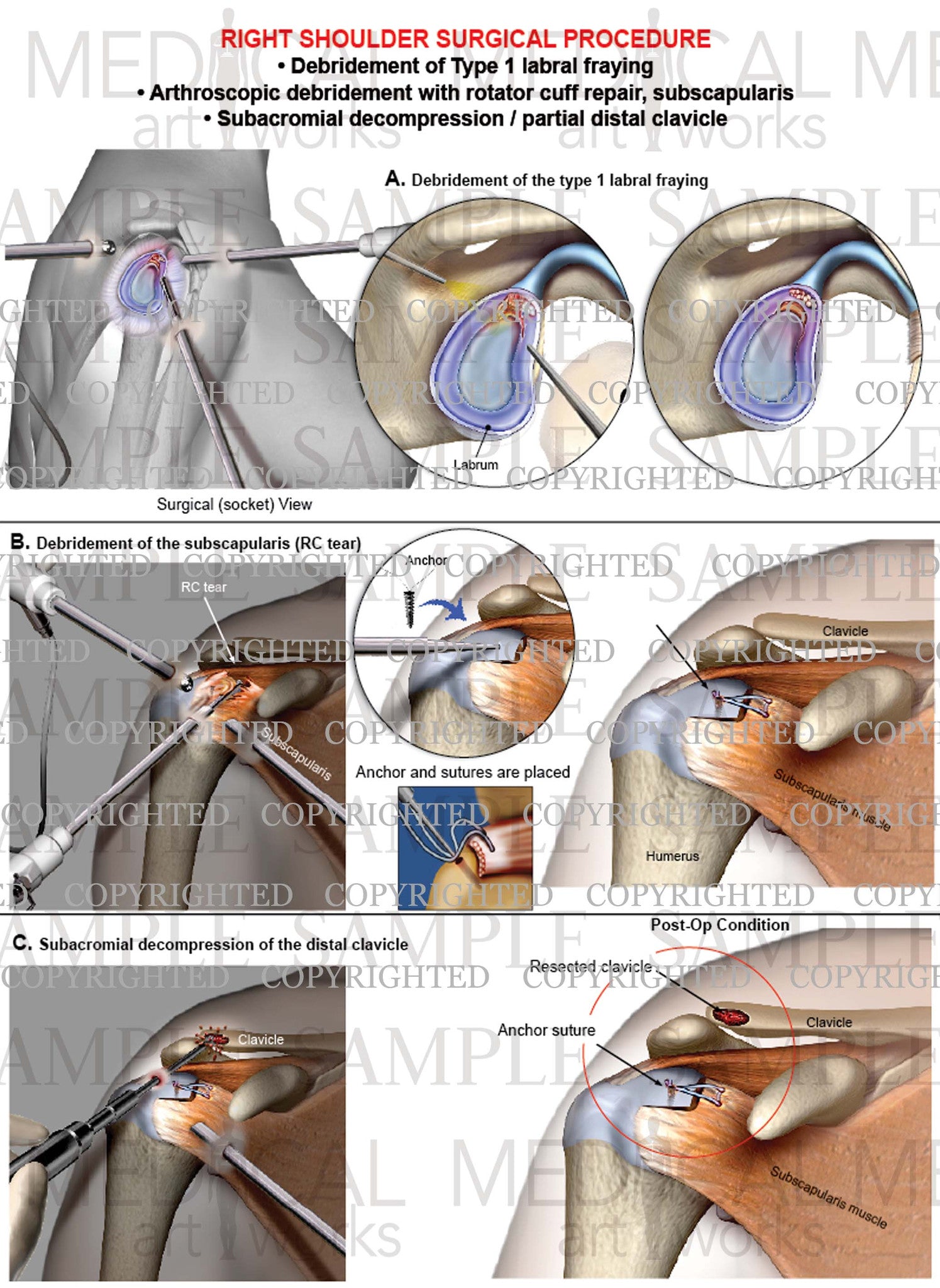 Right shoulder arthroscopic Surgery - RC repair - Decompression - Debr ...