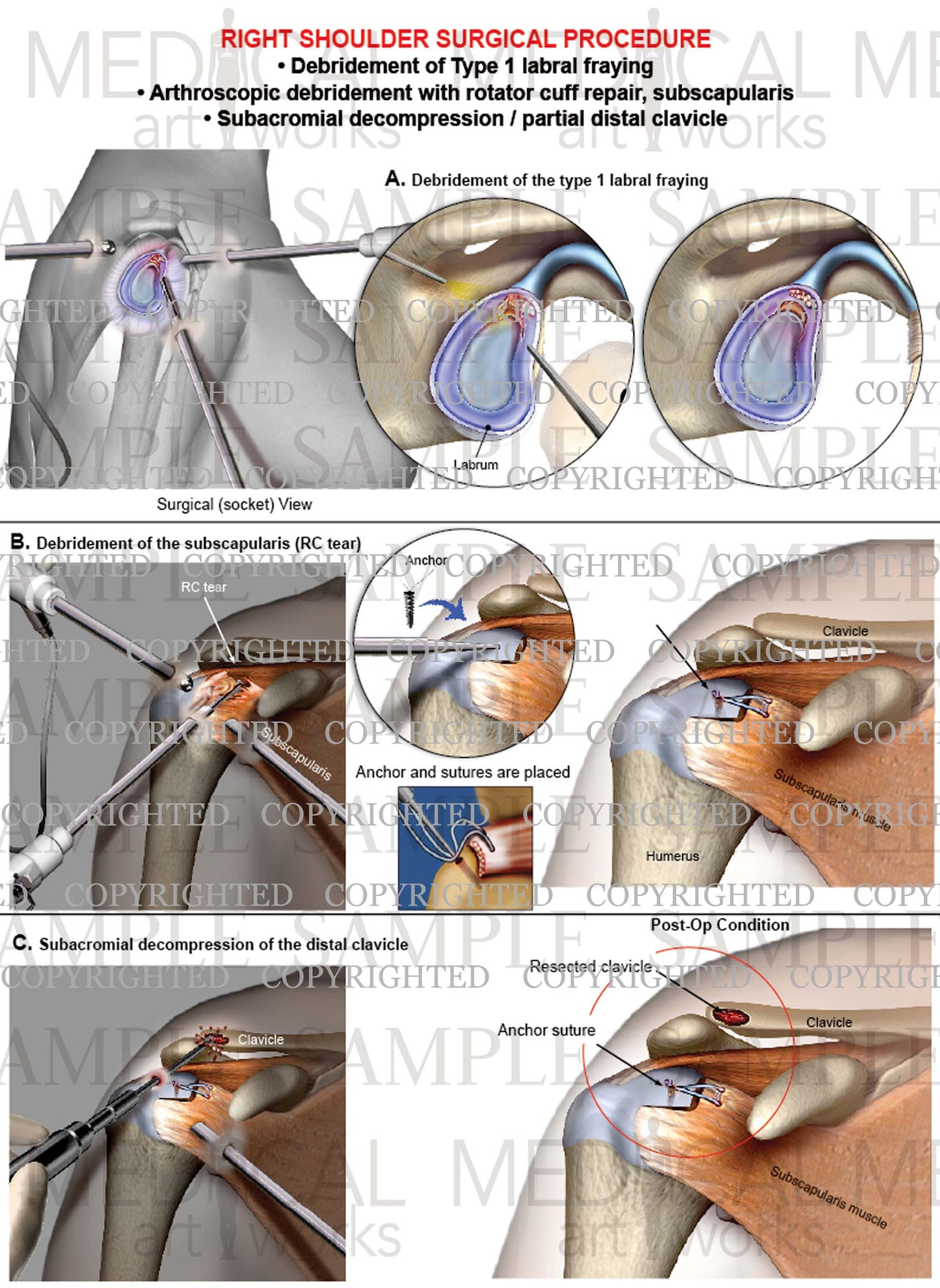 Right shoulder arthroscopic Surgery - RC repair - Decompression - Debridement
