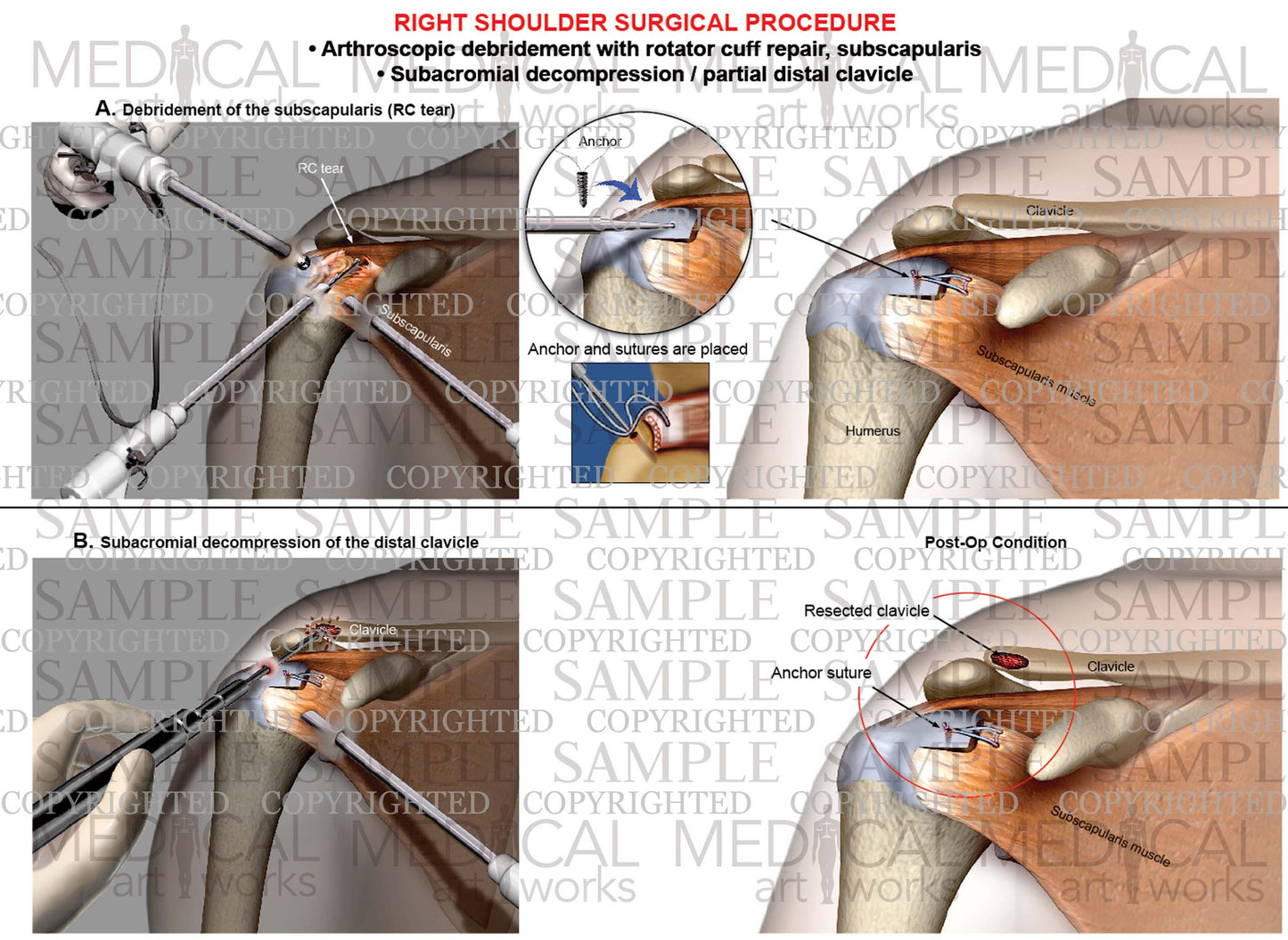 Right shoulder arthroscopic Surgery - RC repair