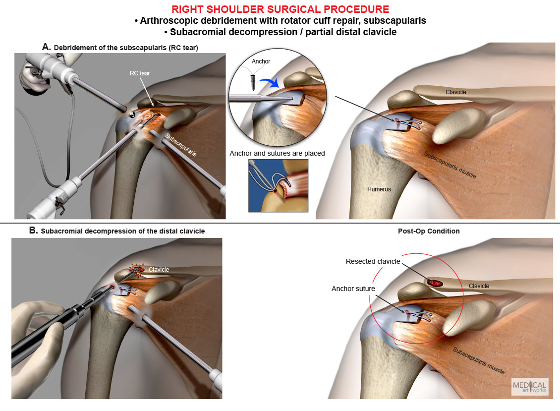 Right shoulder arthroscopic Surgery - RC repair