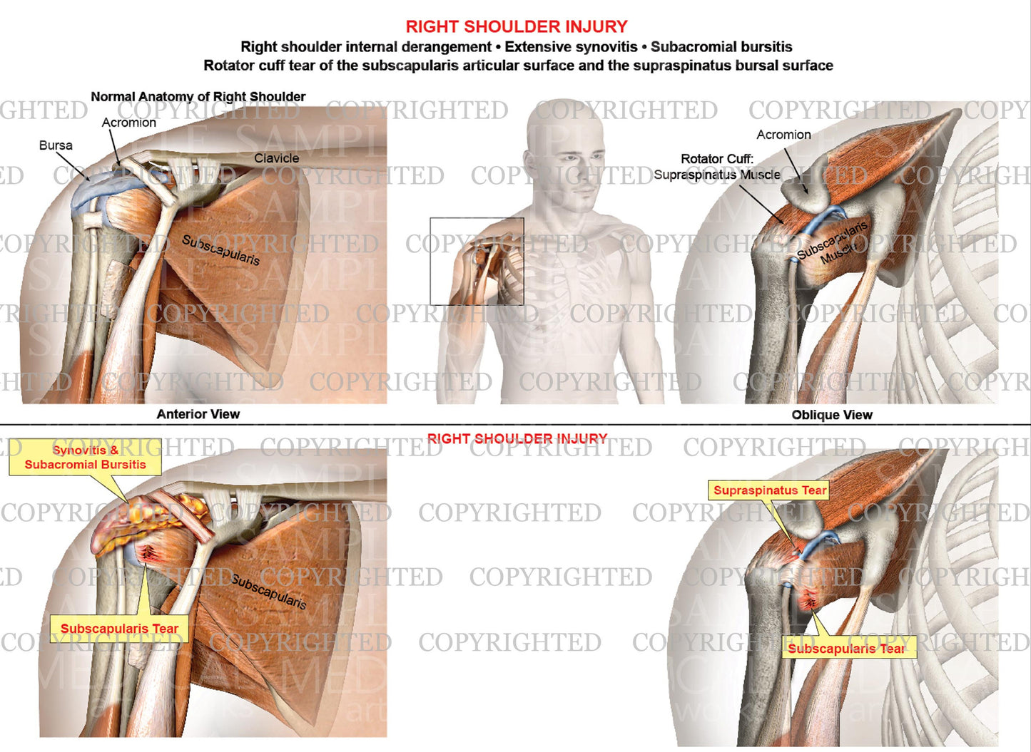 Right shoulder internal derangement - rotator cuff tear - Synovitis - Bursitis